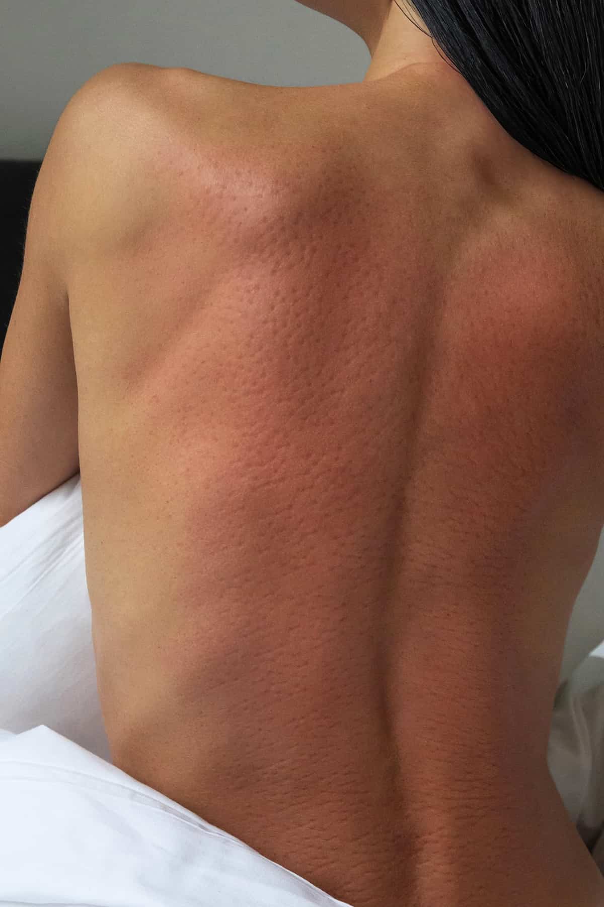 A woman's back with light redness after an acupressure massage